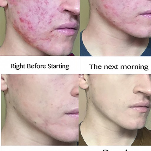 Breakthrough Organic Alternative to Leading Prescription Acne Treatments Developed by 'Z Skin'