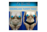 Hourglass Tummy Tuck