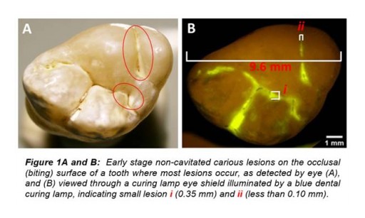 GreenMark Secures Phase II SBIR Funding for Identification of Early Stage Dental Caries