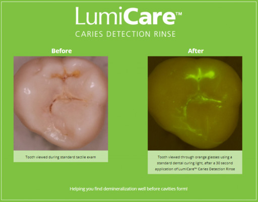 GreenMark Secures FDA Clearance for LumiCare™ Caries Detection Rinse