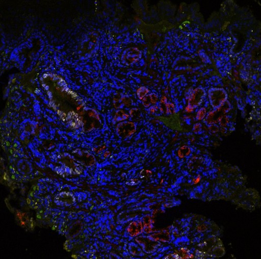 Cernostics Announces Blinded, Independent Validation of TissueCypher(R) Performance for Predicting Risk of Progression to Esophageal Cancer in Patients With Non-Dysplastic BE