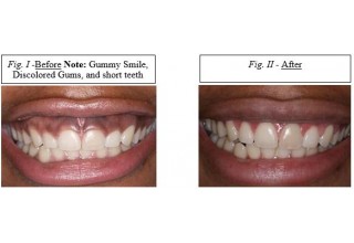 gummy smile