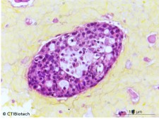 CTIBioTumour