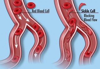 Sickle Cell Disease