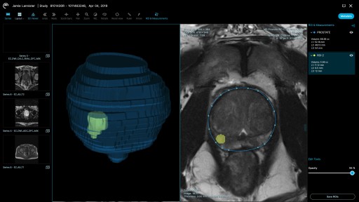 Ezra Receives FDA Clearance for Prostate Cancer Artificial Intelligence