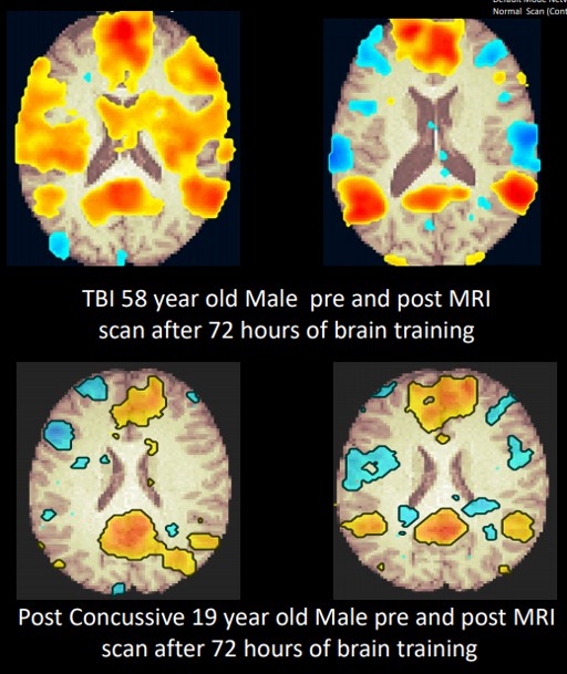 LearningRx Brain Training Reviews the Benefits of Cognitive Baselines for Young Athletes