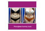 Hourglass Tummy Tuck