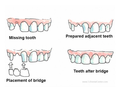 TJ Dental Center Launches Discount Cosmetic Dentistry Packages in Tijuana, Mexico