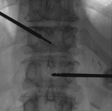 Vertebral body tumor access