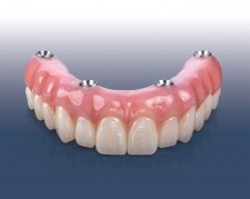 BruxZir® Esthetic Implant Prosthesis