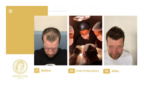 High-Tech Hair Transplants in Turkey Drive the Global Market's Growth