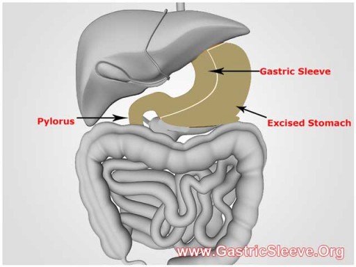 GastricSleeve.org Announces Special Packages for Mexico