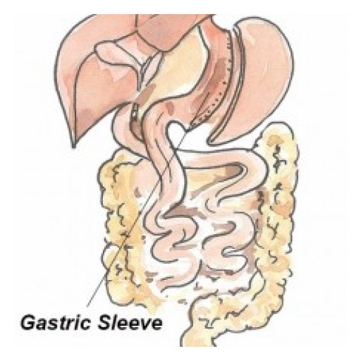 GastricSleeve.org Launches Discount Vertical Sleeve Surgery Packages for Mexico