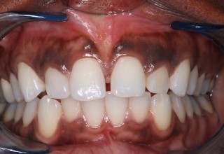 Dark Gums Treatment