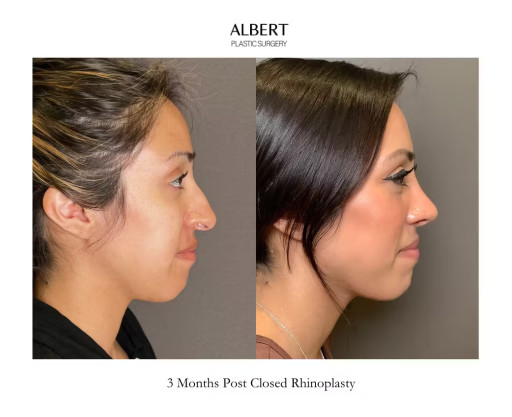 Albert Plastic Surgery's Revolutionary Closed Rhinoplasty Procedure