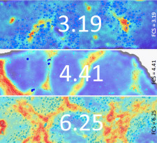 FibroNest's AI scores Fibrosis Severity in Liver Biopsies