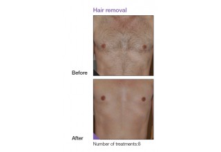 Hair removal