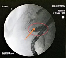 Microwave antenna in bile-duct