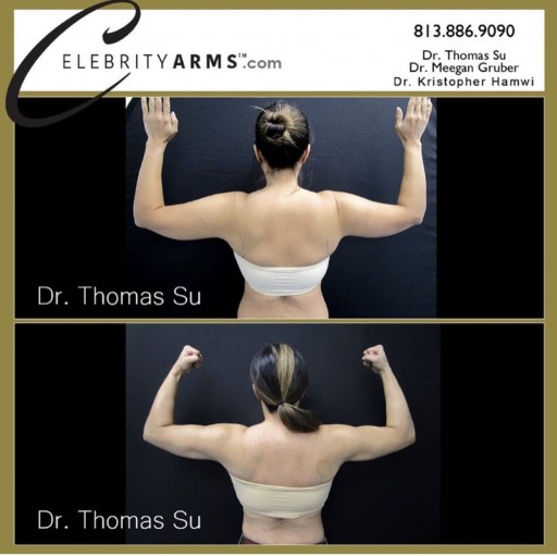 Advanced lipedema treatment by The Roxbury Institute now available