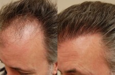 Hair Transplantation