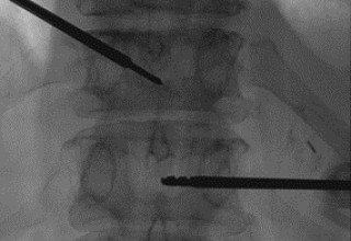 Vertebral body tumor access