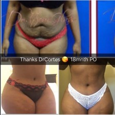 Hourglass Tummy tuck