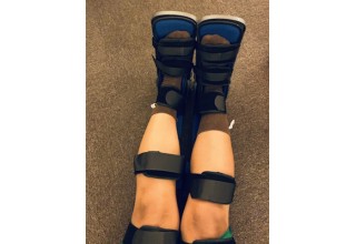 Dancer Nicole Alvarez Uses Equinus Brace In Between Lion King Performances