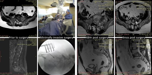 Microwave Energy Used to Successfully Treat a Large, Highly Vascular Sacral Plasmacytoma Tumor