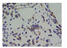 Resistant cells within a high-grade glioma tumor