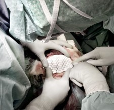 Cranioplasty using OSSDSIGN Cranial PSI