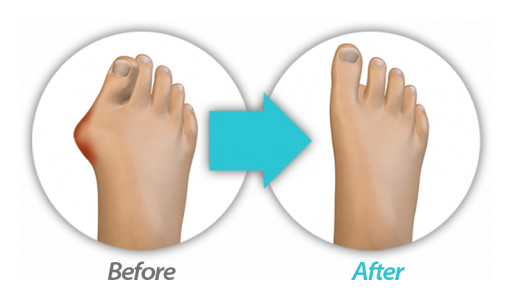 CrossRoads Breaks Through the Bunion Correction Market With Invisible Incision and Four-Dimensional Products