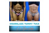 Hourglass Tummy Tuck