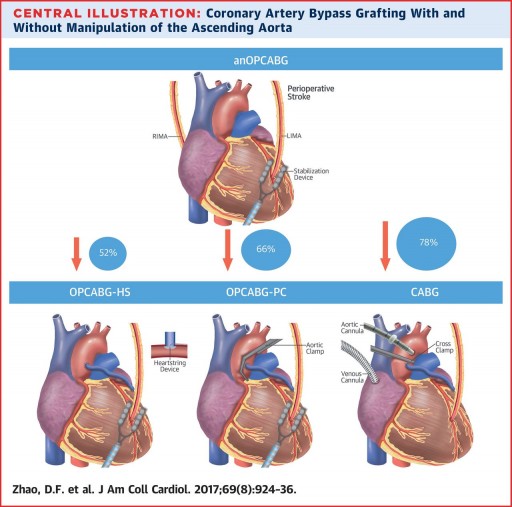 78% Stroke Reduction with Newer No-Touch Beating Heart Bypass Surgery, According to Landmark Study