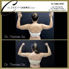 Celebrity Arms Lipo