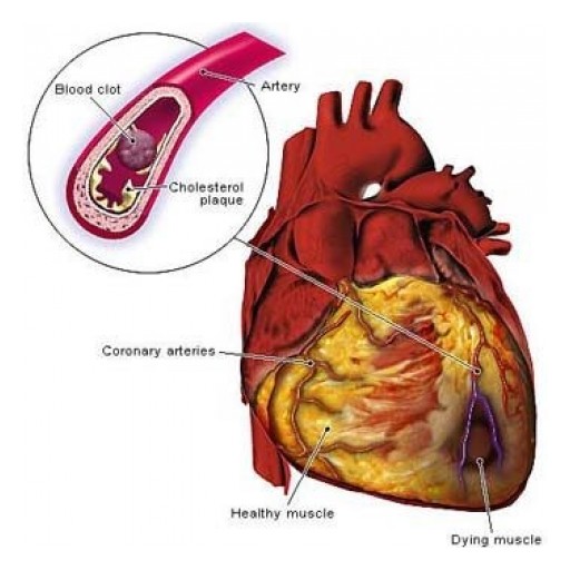 How a Chiropractic Lifestyle Helps Heart Disease and Cancer