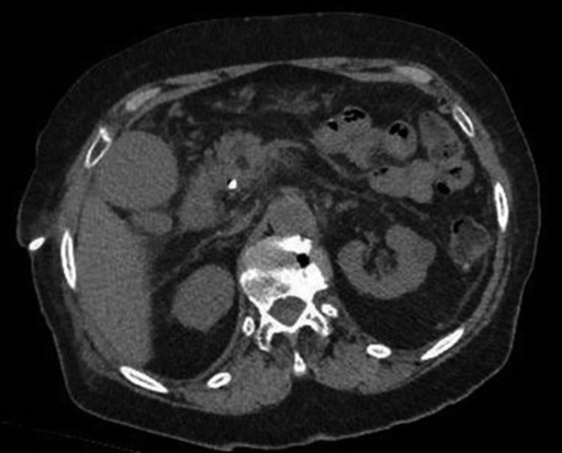 MedWaves AveCure® Ablation System: Doctors in Spain Used Microwave Energy to Successfully Treat Bile Duct Blockage