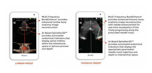 RIVANNA Launches Accuro Second Generation With BoneEnhance® Multi-Frequency Image Reconstruction and SpineNav3D™ AI-Based Spine Recognition