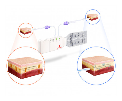 SOMAVAC® Medical Solutions, Inc. Issued US Patent for combined dtNPT and ciNPWT Device