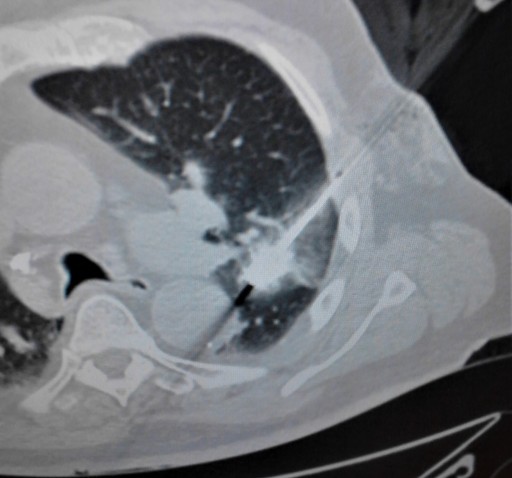 MedWaves AveCure® Ablation System: Microwave Energy Used to Treat Lung Tumor