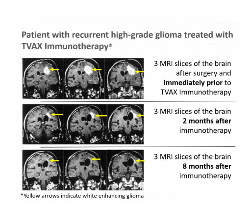 TVAX Biomedical Announces Receipt of $2 Million FDA Orphan Products Grant for Glioblastoma Study