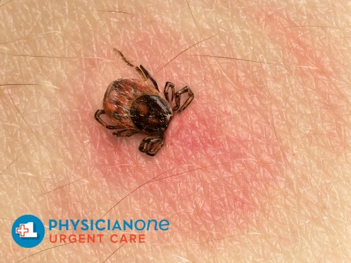 PhysicianOne Urgent Care: With Rising Temperatures, Ticks in the Northeast Are Coming Out of Hiding