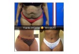 Hourglass Tummy tuck