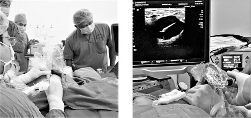 Microwave Energy Used to Successfully Treat Benign Breast Tumors