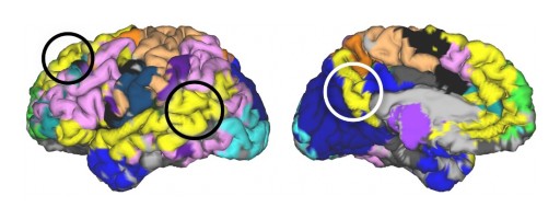 New 3D Brain Mapping Paves the Way for Precise, Personalized Treatments for Symptoms of Alzheimer's and Traumatic Brain Injury