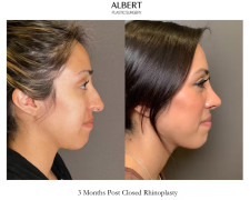 Rhinoplasty