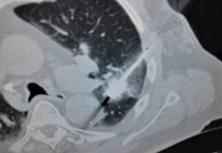 Lung tumor receiving microwave ablation treatment